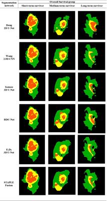 Overall Survival Prediction of Glioma Patients With Multiregional Radiomics